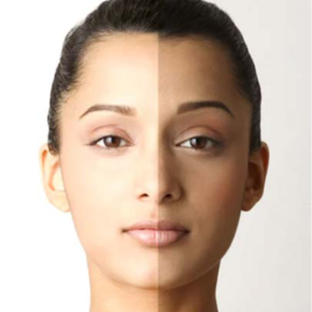 Glutathione Whitening Treatment